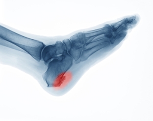 How Does a Heel Spur Form?