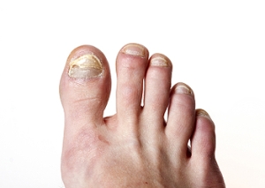 Signs You Have Developed Nail Fungus