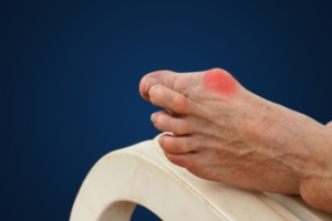 Breaking Down Bunions