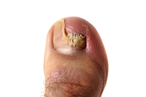 When Your Toenails Start Changing