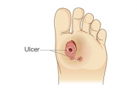 All About Diabetic Foot Ulcers
