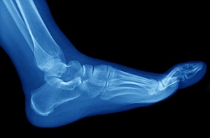 What Causes Hammertoe?