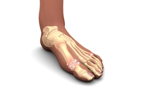 Why Does Gout Develop?