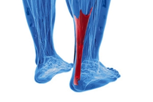 Exploring Achilles Tendonitis
