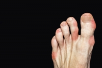 Definition and Risk Factors of Gout