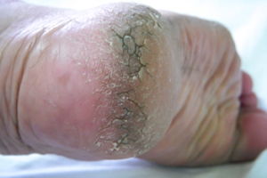 Cracked Heels Can Be Painful