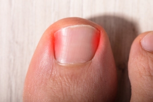 Symptoms of an Ingrown Toenail