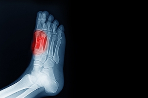Causes and Diagnosis of Sesamoiditis