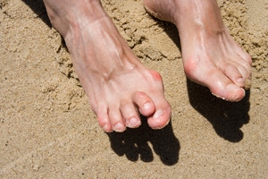 Can Wearing High Heels Cause Hammertoe?