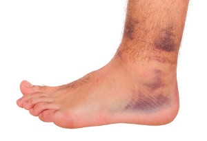 Arthritis, Sprains and Strains