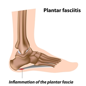 Heel Pain and Plantar Fasciitis