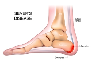 Managing a Child’s Heel Pain