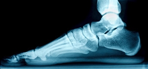 What Are the Signs of Flat Feet?