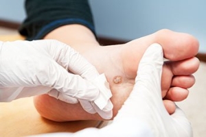 Getting Rid Of Foot Warts